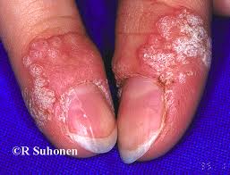 Emberi papillomavírus fertőzés szemölcsök a kezét - Szemölcsök a kézen és a lábon
